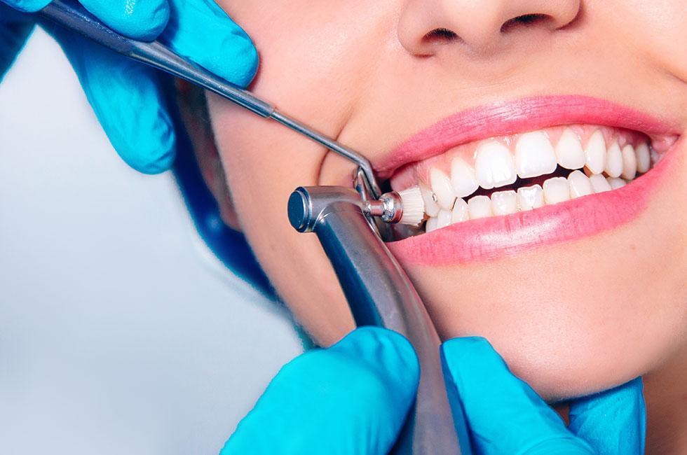 Dental Cleaning (Scaling and Polishing)